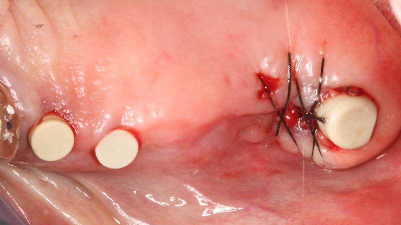 Carico immediato su 12 con moncone conometrico dritto e cappetta provvisoria in peek ribasata in resina su provvisorio. Foto dopo l'intervento con esecuzione flapless e leggera plastica gengivale del Tuber applicazione di cappette di guarigione in peek. Guarigione dei tessuti dopo 3 mesi e impronta digitale definitiva per finalizzare il caso