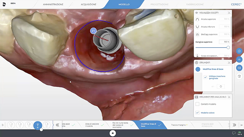 Definizione della maschera gengivale e della corona con profilo di emergenza 2.1
