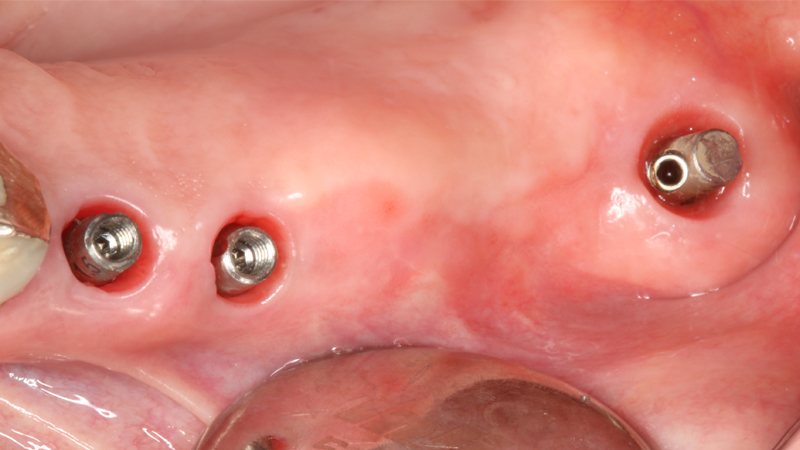 Carico immediato su 12 con moncone conometrico dritto e cappetta provvisoria in peek ribasata in resina su provvisorio. Foto dopo l'intervento con esecuzione flapless e leggera plastica gengivale del Tuber applicazione di cappette di guarigione in peek. Guarigione dei tessuti dopo 3 mesi e impronta digitale definitiva per finalizzare il caso