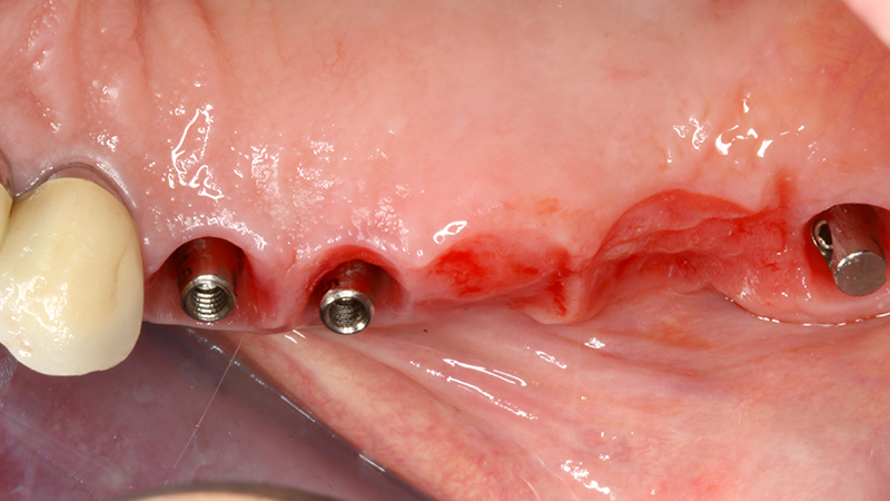 Carico immediato su 12 con moncone conometrico dritto e cappetta provvisoria in peek ribasata in resina su provvisorio. Foto dopo l'intervento con esecuzione flapless e leggera plastica gengivale del Tuber applicazione di cappette di guarigione in peek. Guarigione dei tessuti dopo 3 mesi e impronta digitale definitiva per finalizzare il caso