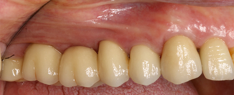 Applicazione ponte 17-14 in metallo ceramica su cappette conometriche passivate in bocca mediante cemento