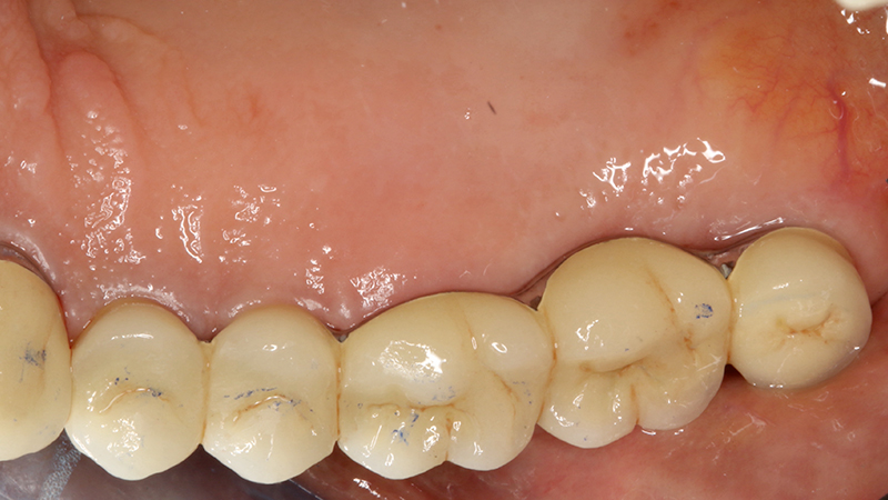 Applicazione ponte 17 - 14 in metallo ceramica su cappette conometriche passivate in bocca mediante cemento Multilink Hybrid e risultato finale