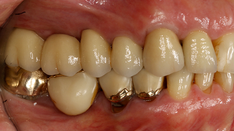 Applicazione ponte 17 - 14 in metallo ceramica su cappette conometriche passivate in bocca mediante cemento Multilink Hybrid e risultato finale