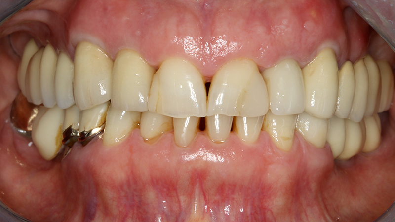 Applicazione ponte 17 - 14 in metallo ceramica su cappette conometriche passivate in bocca mediante cemento Multilink Hybrid e risultato finale