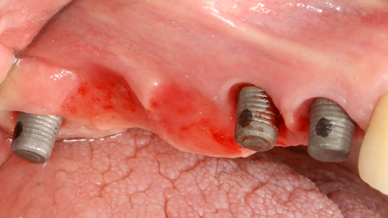 Applicazione ponte 17 - 14 in metallo ceramica su cappette conometriche passivate in bocca mediante cemento Multilink Hybrid e risultato finale