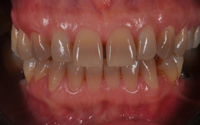 presenza di diffusa pigmentazione su entrambe le arcate