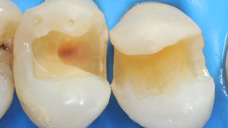 Rimozione dei vecchi restauri e ottenimento di due cavità di II classe