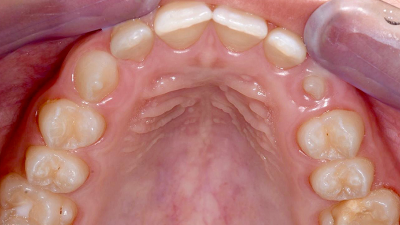 Situazione iniziale, vista palatale