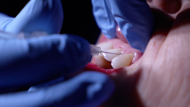 Trattamento Carbossiterapia