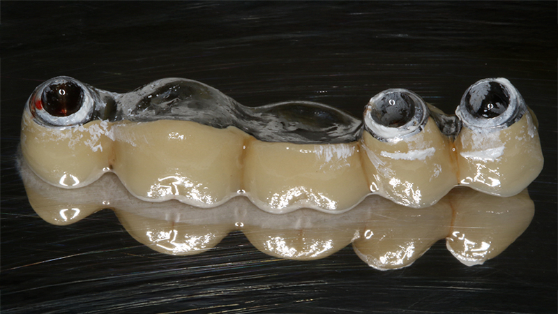 Applicazione ponte 17 - 14 in metallo ceramica su cappette conometriche passivate in bocca mediante cemento Multilink Hybrid e risultato finale