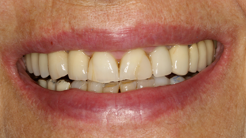 Applicazione ponte 17 - 14 in metallo ceramica su cappette conometriche passivate in bocca mediante cemento Multilink Hybrid e risultato finale