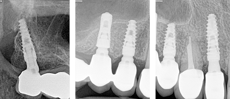 Figs. 32, 33, 34 - Radiografie finali impianti 17, 15, 14 ad un anno dal carico con guarigione del rialzo di seno trans-crestale del 15, impianto pterigoideo 17 e Socket Shield 12