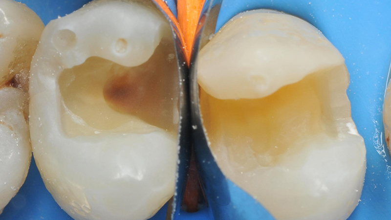 posizionamento di due matrici sezionali per ottenere dei punti di contatto corretti e adeguati