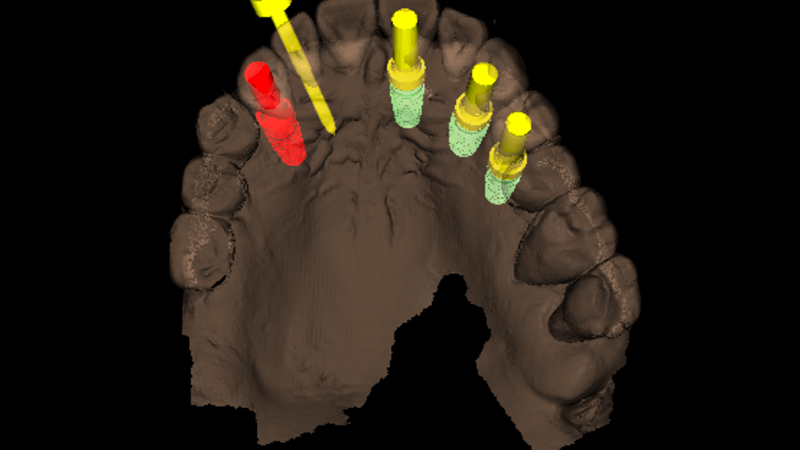 Pianificazione chirurgica mediante R2Gate