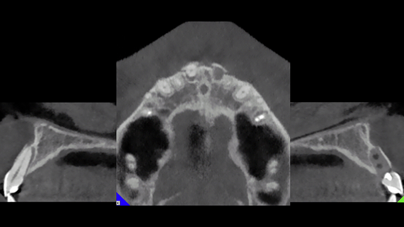 CBCT dopo il trauma