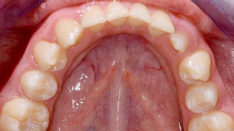 Situazione iniziale, vista palatale