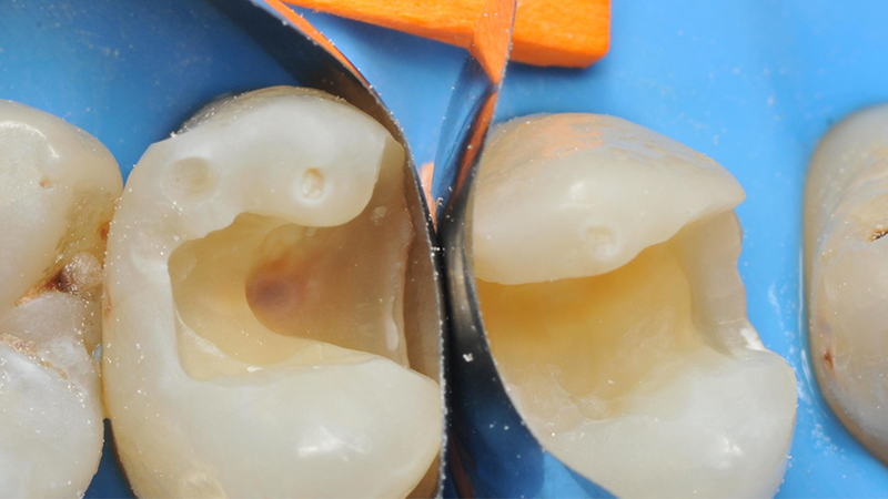 La parte esterna del cuneo è stata spezzata per fare in modo che rimanesse solo nella zona interprossimale