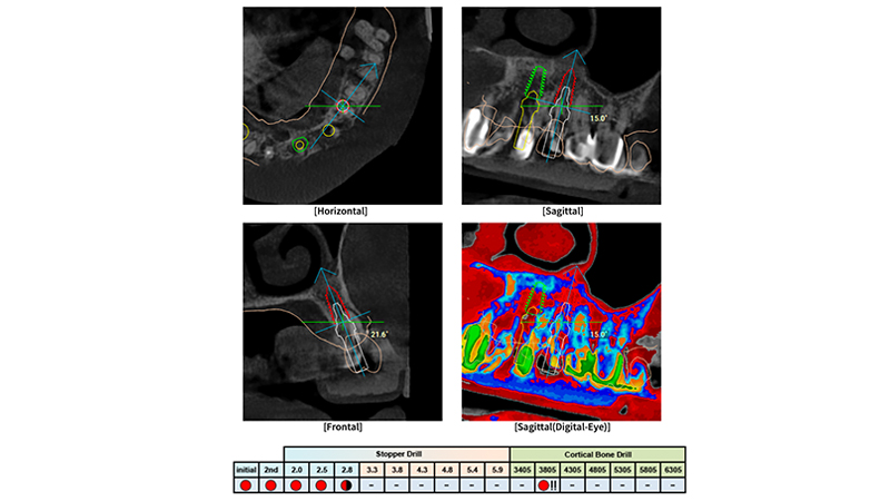 Pianificazione chirurgica associata a Digital Eye