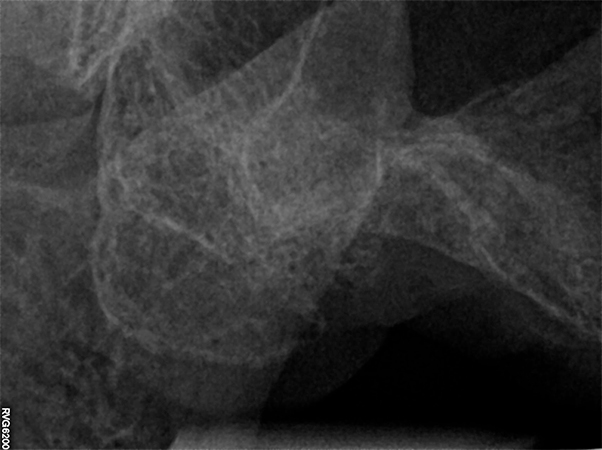guarigione in zona Tuber dopo 3 mesi
