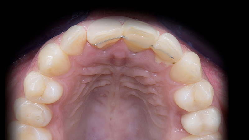 Soluzione d'emergenza 