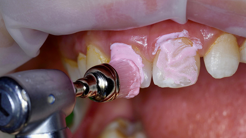 Attivazione Opalustre Ultradent con spazzolino in gomma