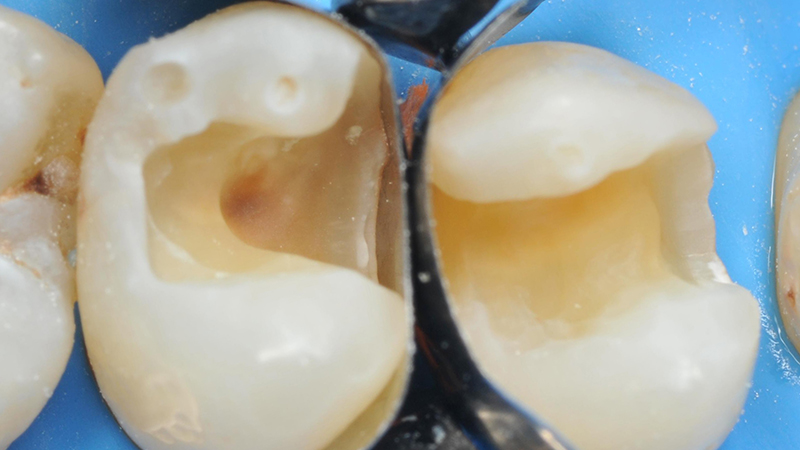 l'anello utilizzato spingeva la matrice nel modo più forte possibile contro la superficie del dente, ripristinando le corrette proporzioni dei due denti