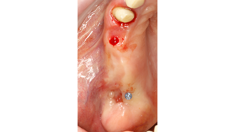 Guarigione dopo 3 mesi, inserimento minivite Ustomed per inserire repere ed aumentare la precisione del Navigatore in zona edentula. Esecuzione della Cone Beam con repere per il protocollo "instant registration"