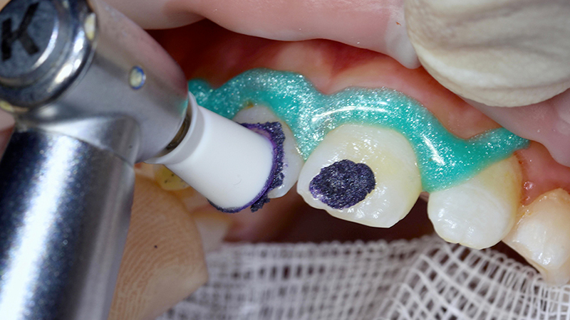 Applicazione gel mordenzante Icon-Etch