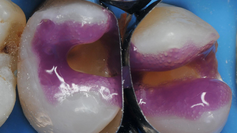 mordenzatura selettiva dello smalto per 30 secondi