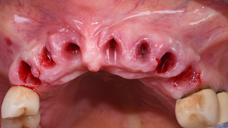 Alveoli post-estrattivi prima di applicare R2Guide