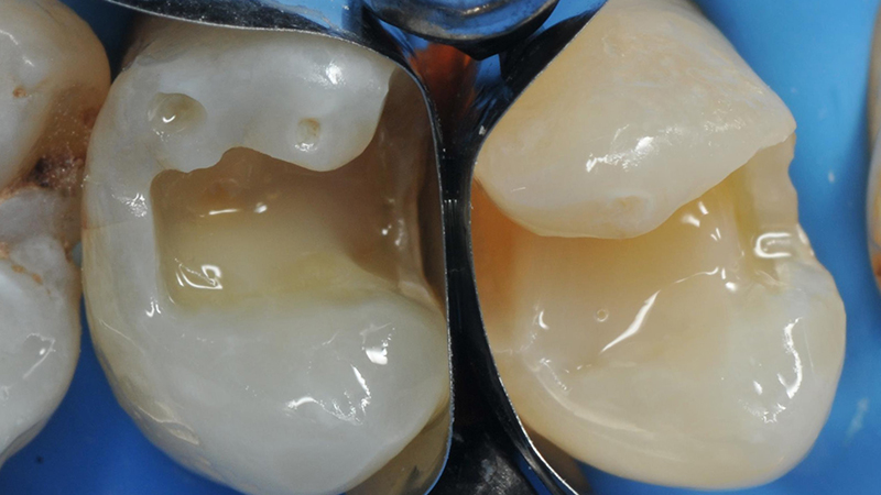 è stato applicato l’Optibond Universal di Kerr per l’adesione