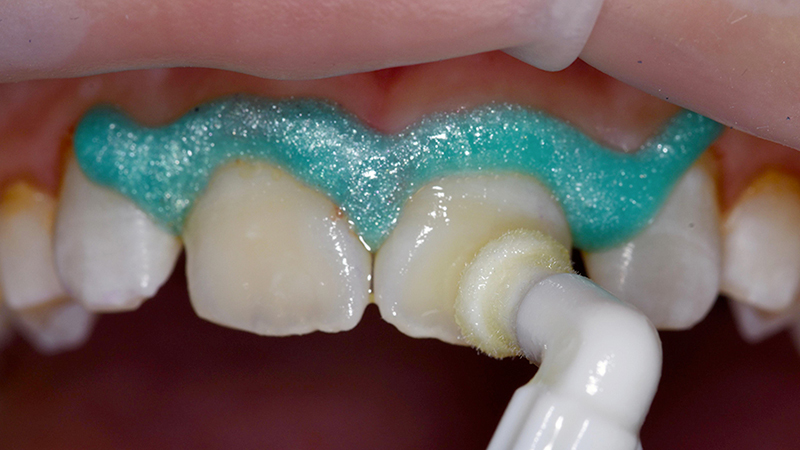 Nuovo Tip Icon-Infiltrant