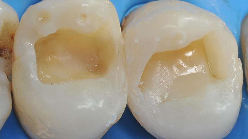 è stato applicato un sottile strato di composito bulk fill flow per rivestire e proteggere lo strato ibrido e regolarizzare il pavimento della cavità