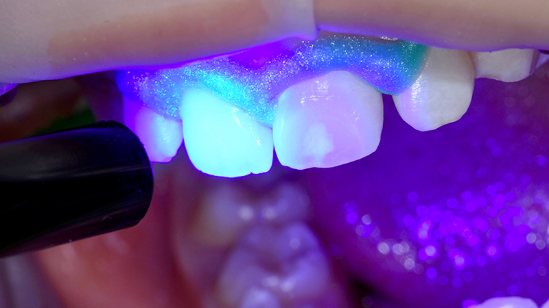 fotopolimerizzazione per 40 secondi