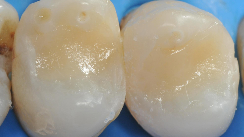 Per completare il riempimento della cavità è stata applicato un sottile strato di composito bulk fill flow per rivestire e proteggere lo strato ibrido e regolarizzare il pavimento della cavità