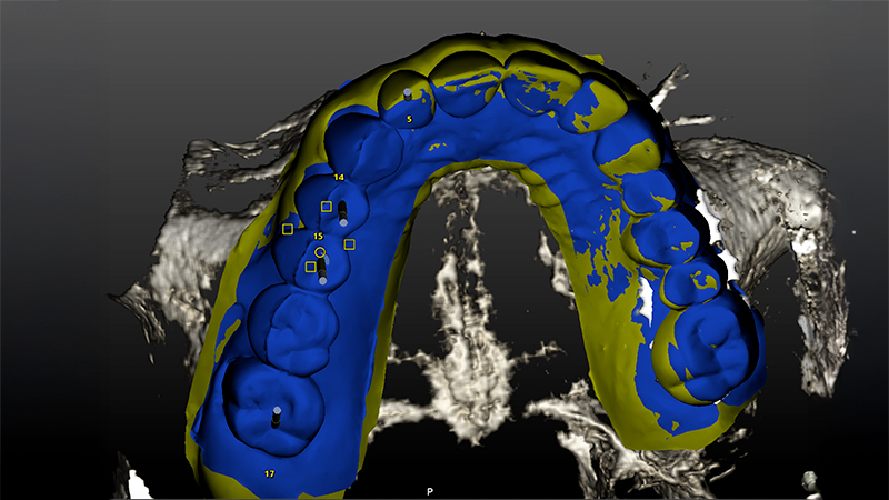 Pianificazione chirurgica della posizione implantare