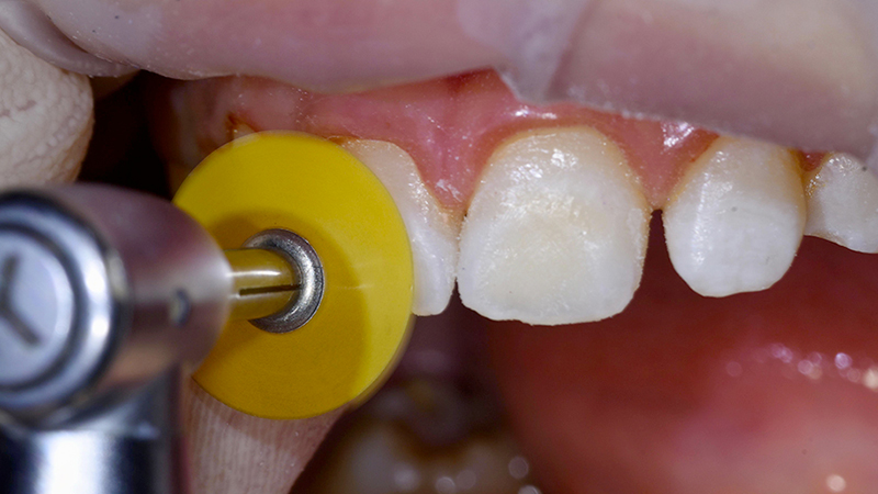lucidatura del dente con dischi lucidanti