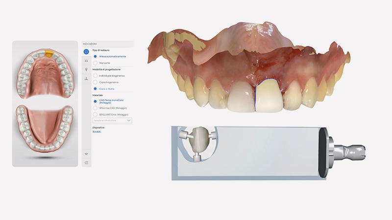 Progetto digitale del dente 2.1