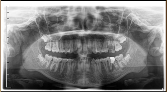 Ortopanoramica pre-trattamento della paziente. I due primi molari sinistri appaiono irrimediabilmente compromessi da carie destruenti
