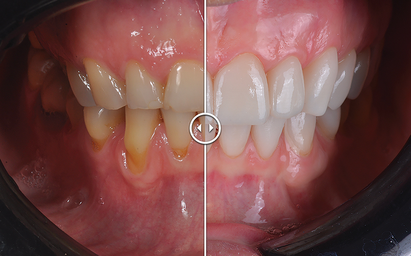 Faccette full digital