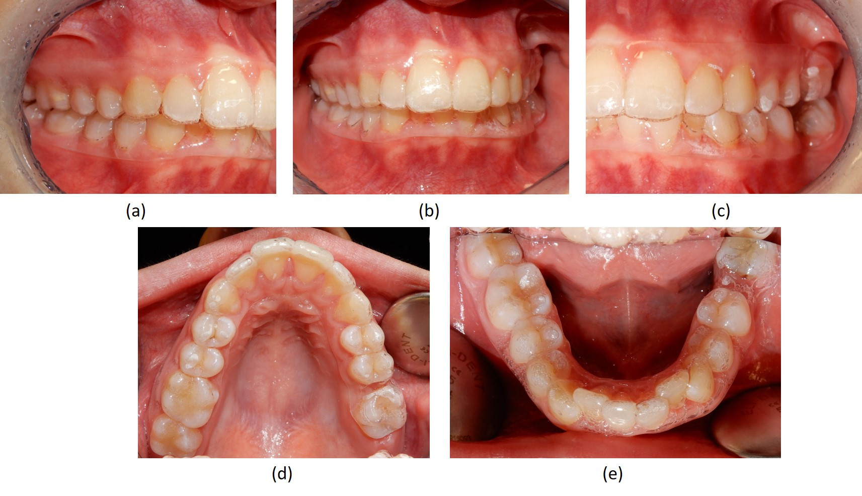 Fig. 5 Foto di controllo con l'allineatore 9