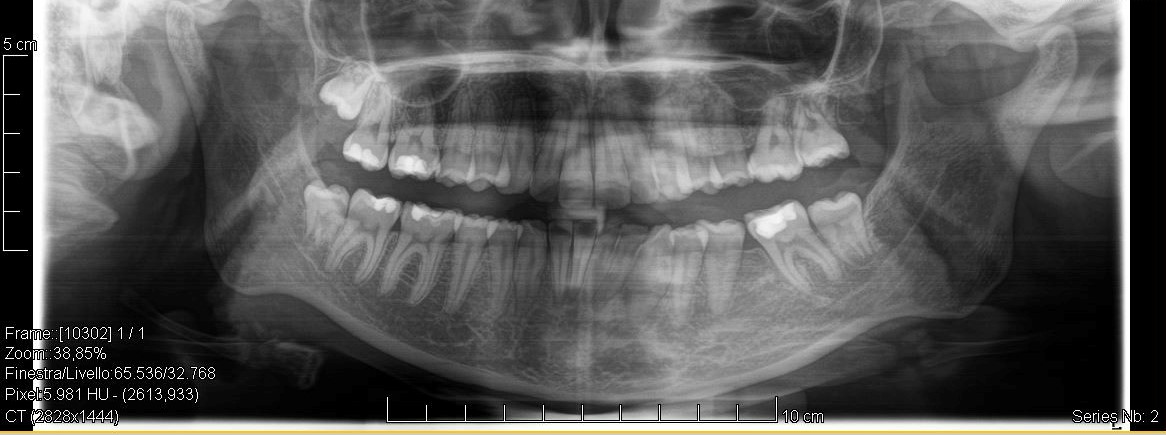 Ortopanoramica post-trattamento che mostra la chiusura degli spazi estrattivi