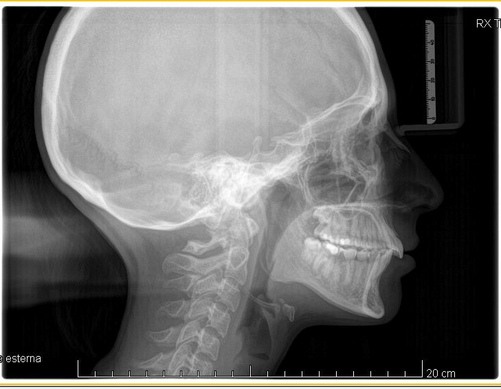 Teleradiografia latero-laterale post-trattamento