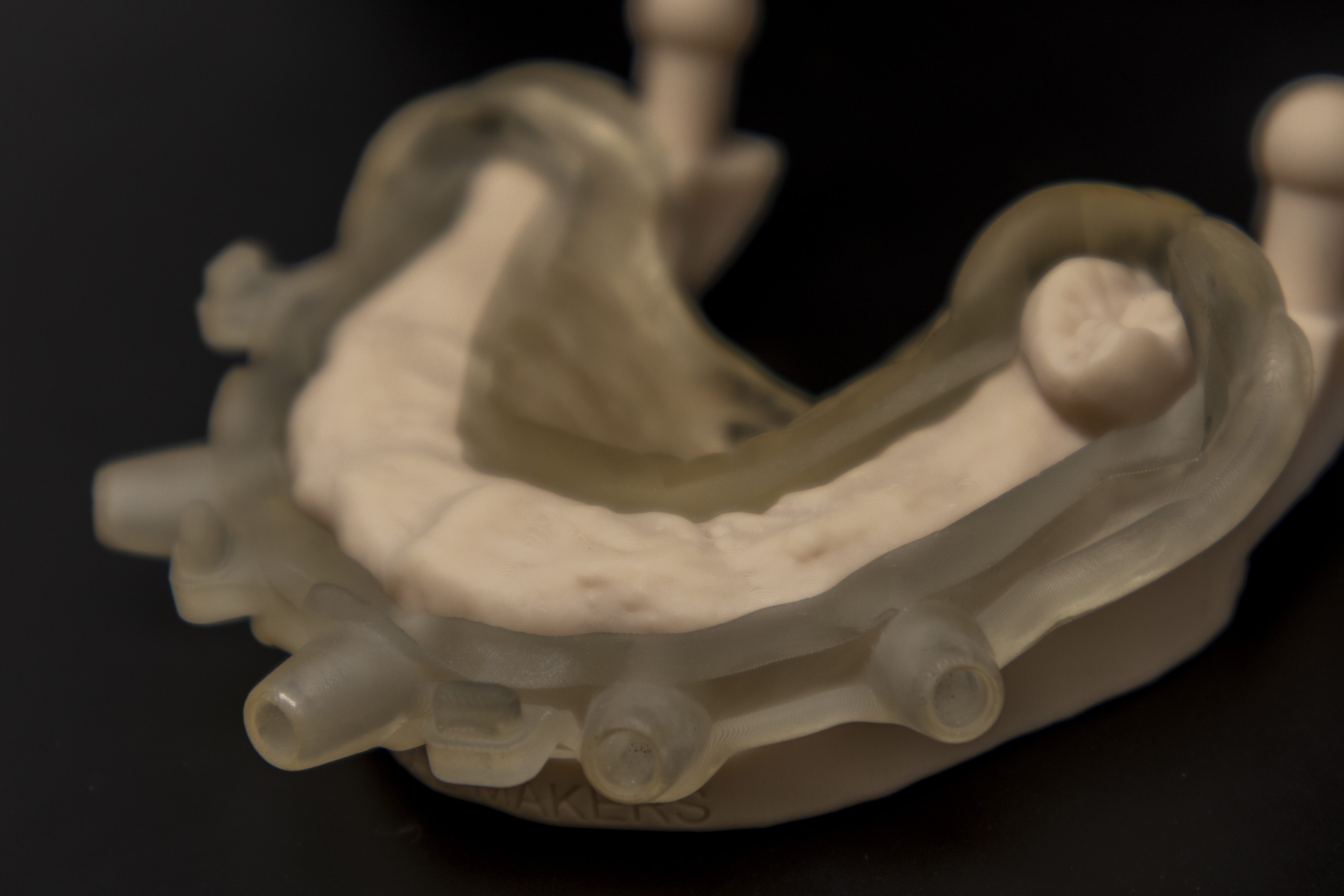 Protesi finita e toronto bridge 3