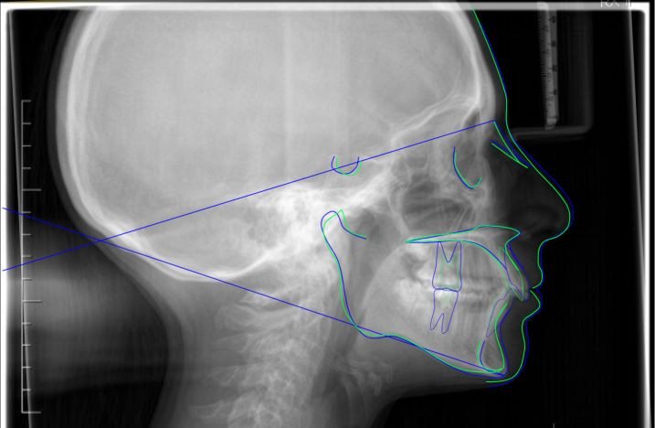 Sovrapposizione dei tracciati cefalometrici