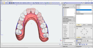 allineatore virtuale