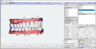altezza liea taglio vestibolatore