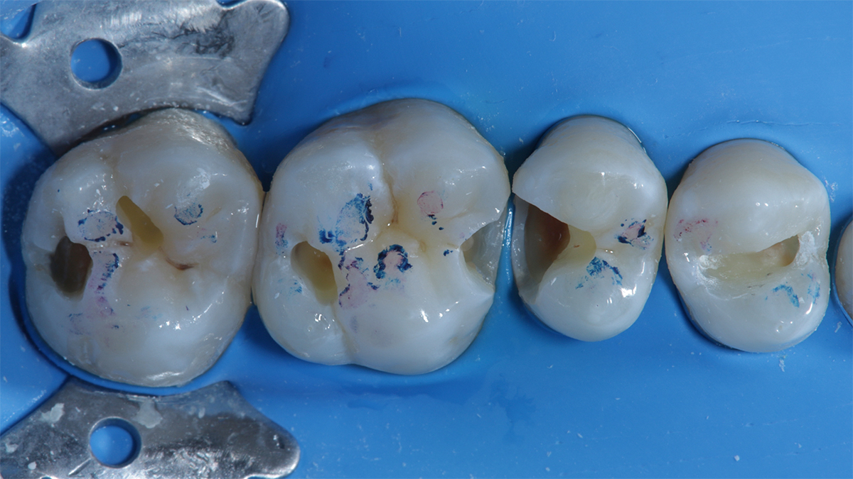 Spazio interdentale stretto