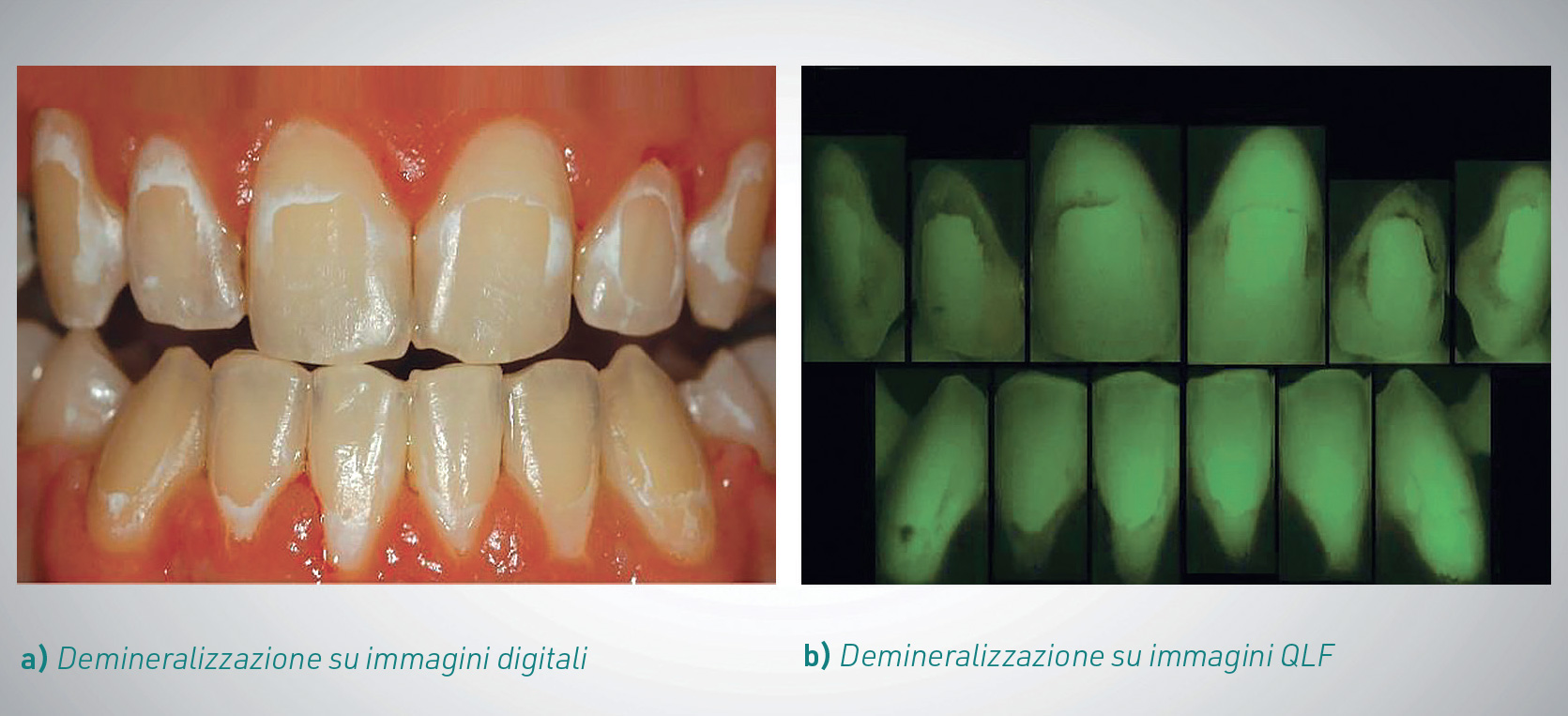 Demineralizzazione su immagini digitali e QLF