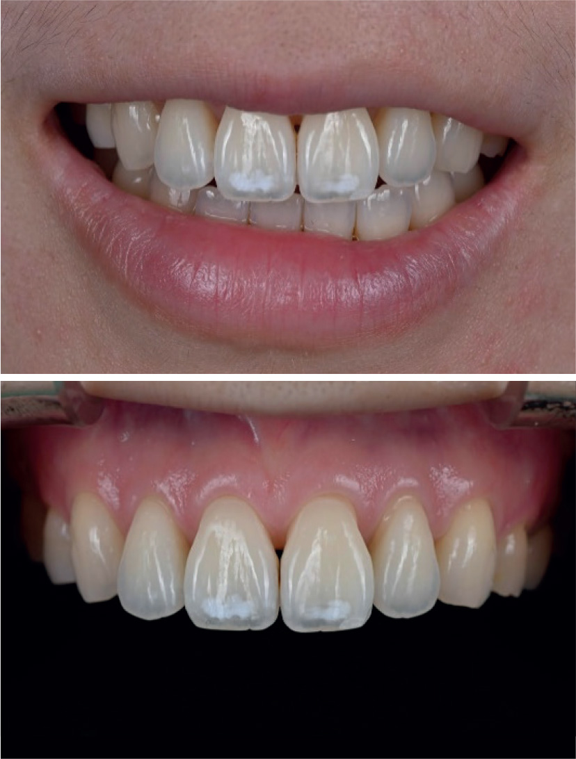 paziente con lesioni dello smalto a livello degli elementi 11 e 21